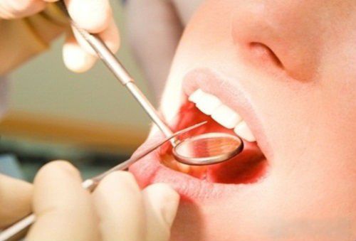 Lấy cao răng giúp phòng chống hôi miệng