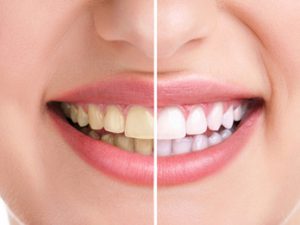 Thực phẩm giúp cải thiện răng bị ố vàng