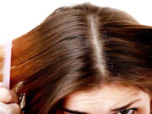 Mặt nạ trị gàu cho mái tóc dầu